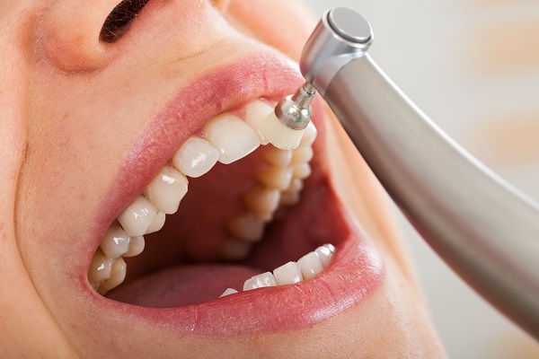 How Often A Dentist Recommends A Dental Cleaning