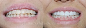 Dental-Veneers-Before-After-2013