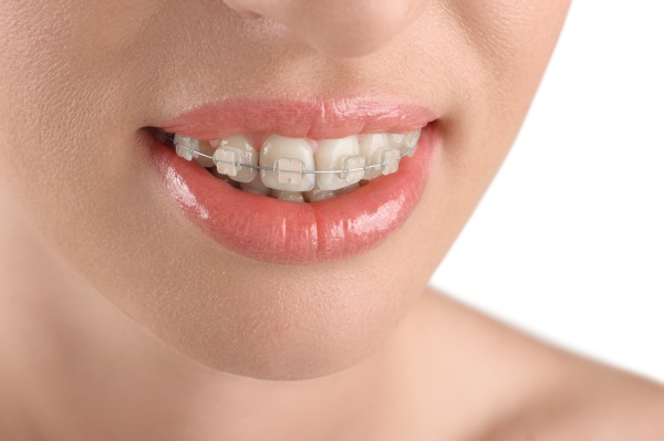Clear Aligners: An Alternative To Braces For Adults