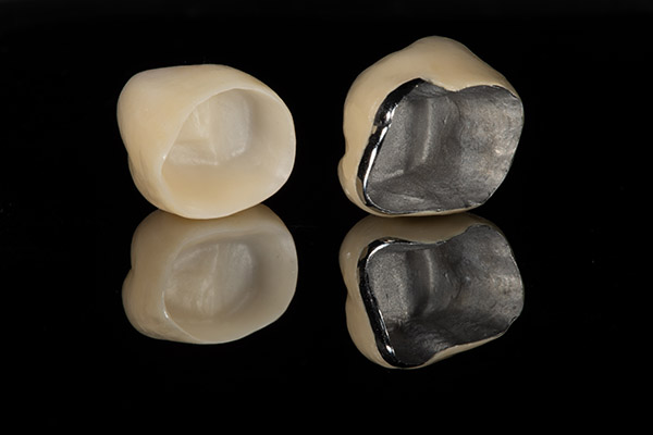 Will I Need a Dental Crown After a Root Canal Treatment? from South Florida Dental Arts in Miami, FL