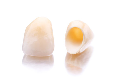 The Important Role Dental Crowns Play At Our Miami Dental Office