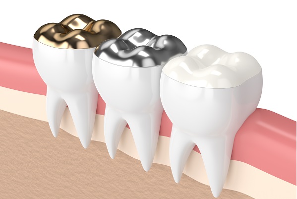 How Does A Dental Filling Fix A Cavity?