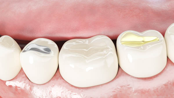How A Dental Filling Is Used For A Cavity