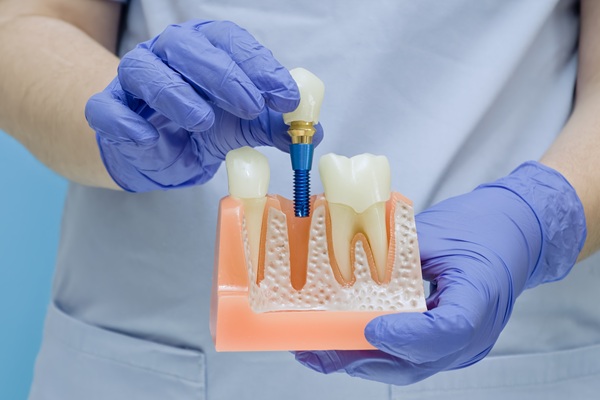 Proper Dental Implant Care In Your Oral Hygiene Routine