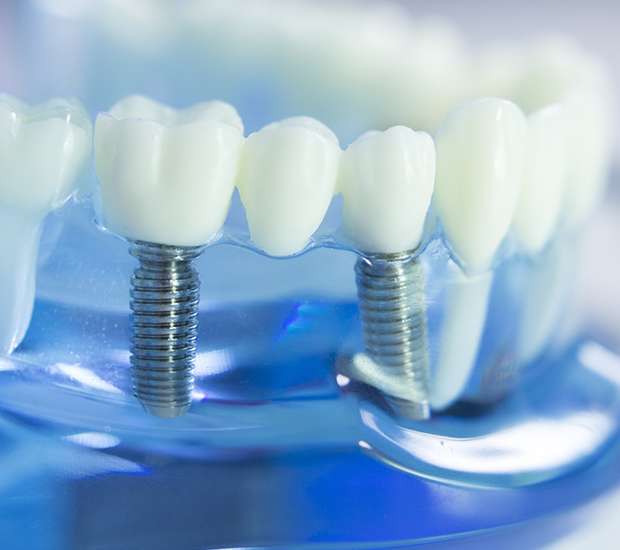 Miami Dental Implants