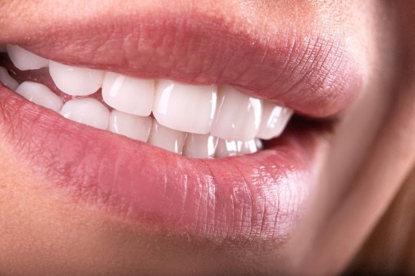 Can Dental Veneers Improve My Smile?