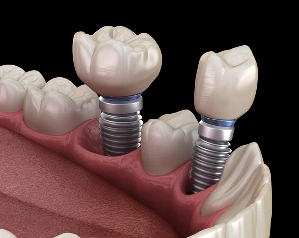 Do Dental Implants Look Natural?