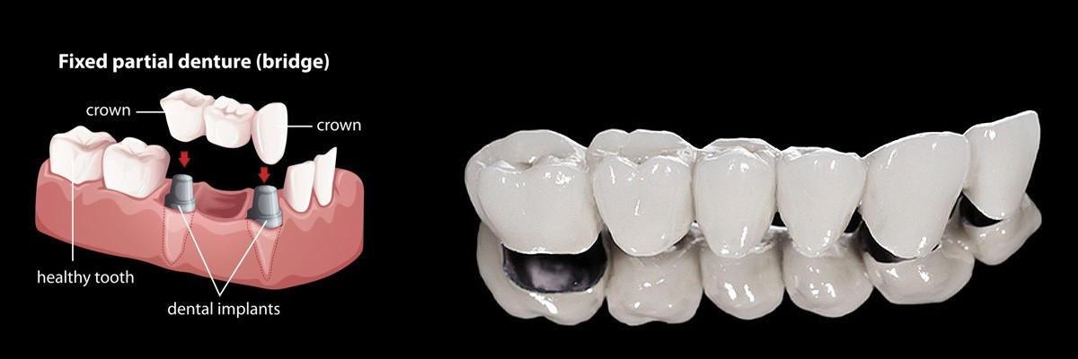 Miami Dentures