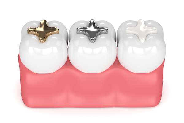 A General Dentist Discusses Different Filling Options from South Florida Dental Arts in Miami, FL