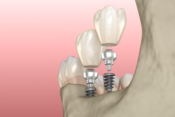 What Procedures Does An Implant Dentist Perform?