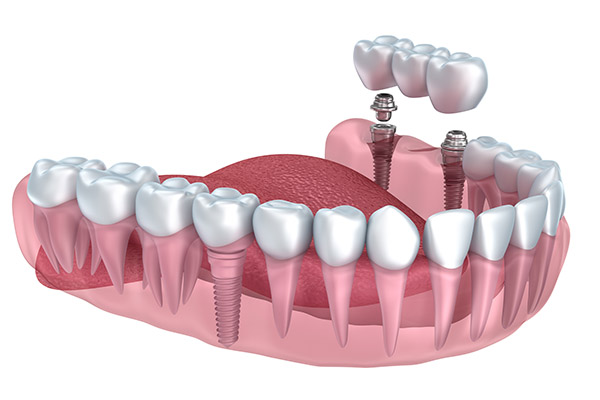 Implant Dentistry Supported Bridge