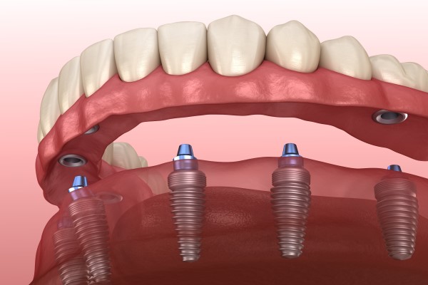 Implant Supported Dentures Miami, FL