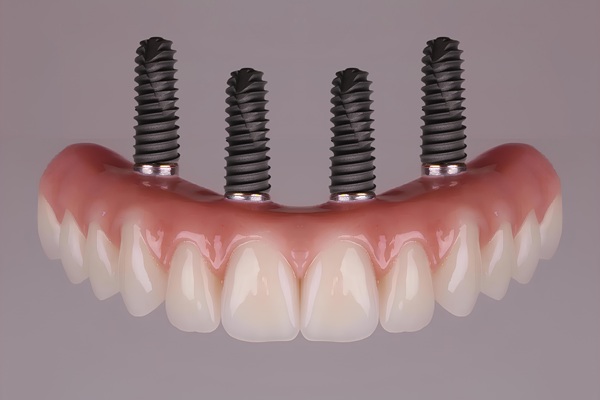 A Guide To The Implant Supported Dentures Procedure
