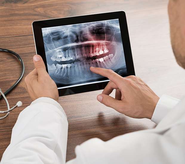 Miami Types of Dental Root Fractures