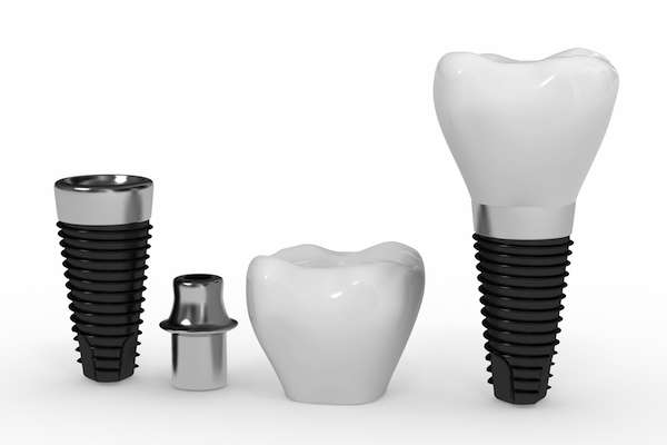 What Are the Parts of Dental Implants from South Florida Dental Arts in Miami, FL
