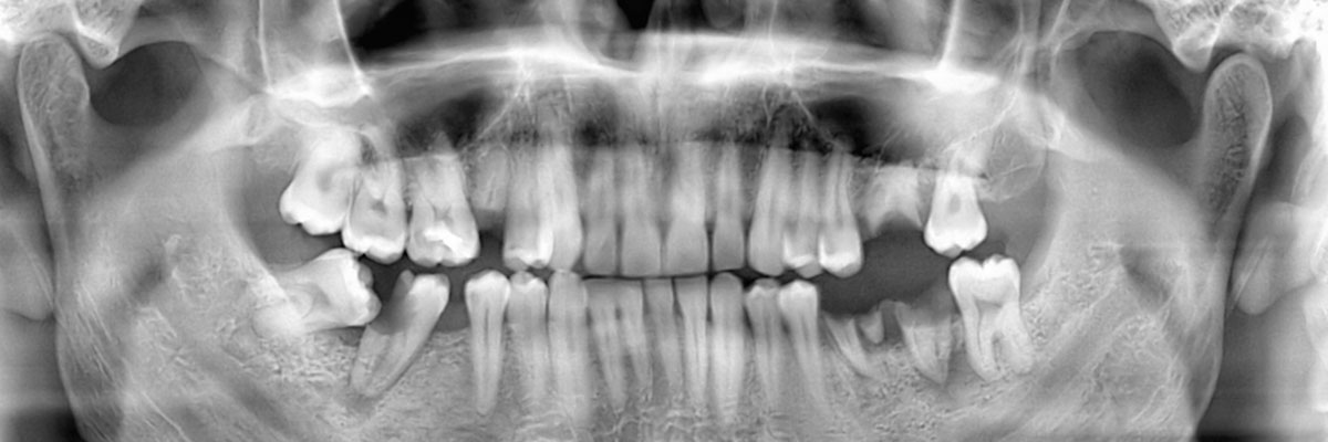 Miami Wisdom Teeth Extraction